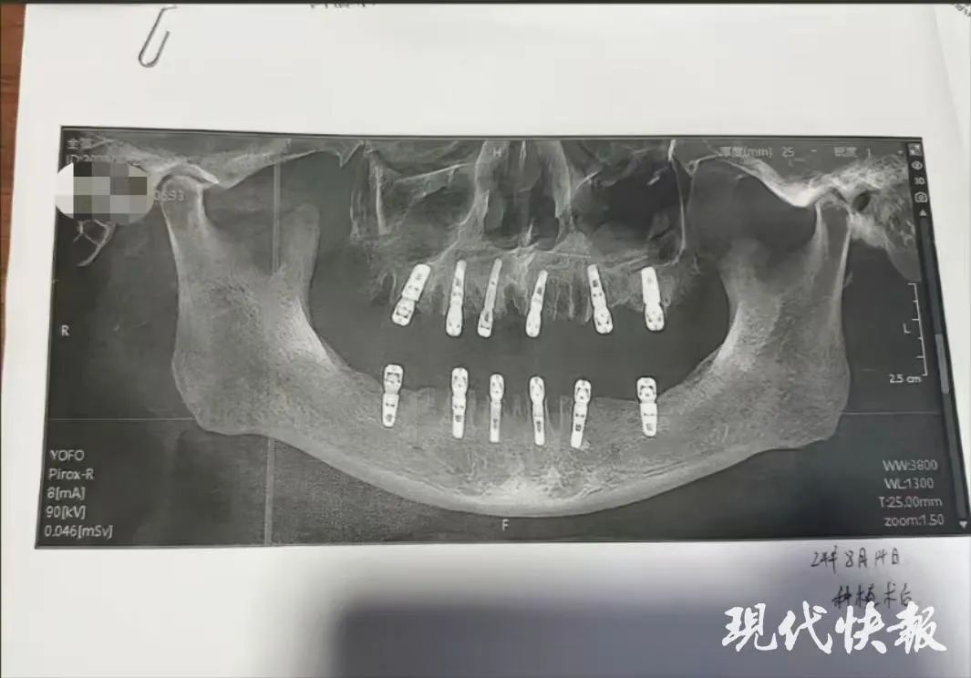 男子一次性拔牙23颗种12颗，13天后去世(图1)